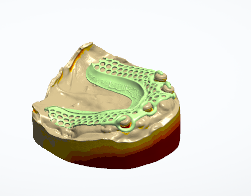 Anterior Splints