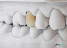 Mouthgaurds